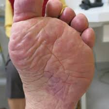 Erythema ab igne can mimic palmar erythema, and patients with atopic diathesis are more likely to have palmar erythema than matched control subjects. Palmar Erythema With Slight Edema Toes Are Involved As Well Download Scientific Diagram