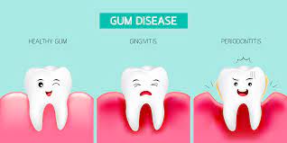 how to avoid gum disease what you need