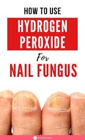 There are some companies the offers remedies for toenail fungus using bleach. Pin On Toe Nail Fungus