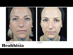 Once it works, however, you will definitely feel and see the difference. The New Baby Botox This Is Exactly What Happens To Your Face Healthista