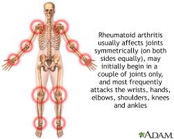 Rheumatoid Arthritis Case Studies Show Diet Success