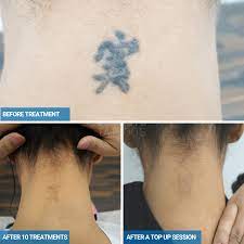 laser tattoo removal completely remove