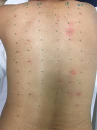 Allergy grid on a patient's back.