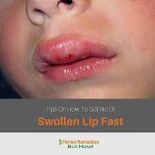 get rid of a swollen lip fast