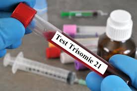 La trisomie 21 est la plus fréquente des anomalies chromosomiques humaines. Umstrittener Test Auf Trisomie 21 Bei Ungeborenen Kindern