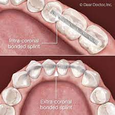If you do nothing, you're heading for some lost teeth. Have A Loose Tooth You Ll Need This Two Phase Treatment To Save It North Creek Dental Care Of Naperville