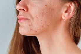 acne tips beaux medspa