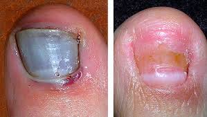 black toe nails dr howard green