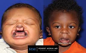 a child s cleft lip and palate journey
