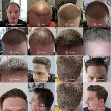 hair transplant recovery timeline 0