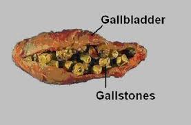 7 tips for natural gallbladder remes