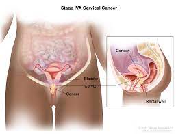 cervical cancer treatment pdq cancer