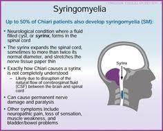 Syringomyelia Spinal Cord Disorders