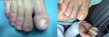nail prosthesis klinik for fodterapi