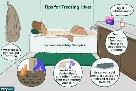 hives urticaria treatment