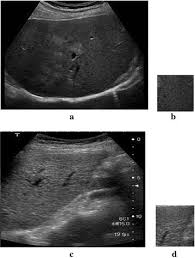 ultrasound image of normal liver b roi