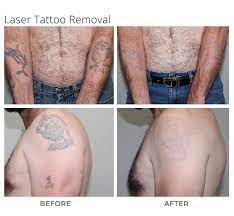 laser tattoo removal msa plastic surgery