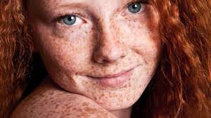 have freckles