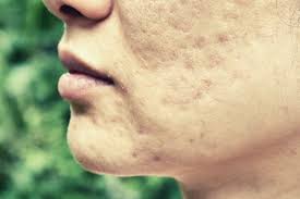 how to get rid of pitted acne scars 3