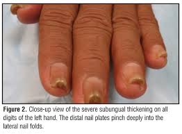 acquired pincer nail deformity