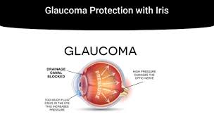 Learn more about the types, causes, symptoms, risk factors, diagnosis, and treatment of glaucoma causes. Glaucoma Protection With Iris Iristech
