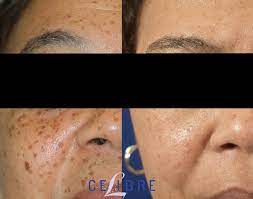 laser treatment for dark skin