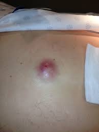 abscess incision and drainage a