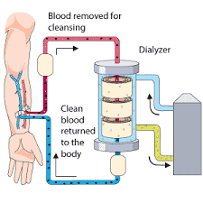 Hemodialysis System Chart Depicts The Dialyzer Blood