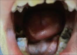 movable m in the floor of the mouth