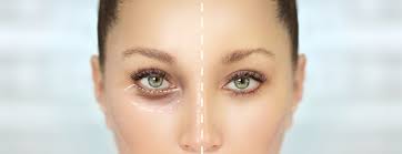 droopy eyelid and ptosis repair