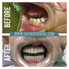 • whenever you need to relieve the pain from tooth decay, you could use this method. Preventing Tooth Decay Cavities Hayner Dental