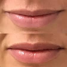 botox lip flip overview arteca