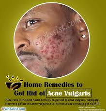about acne vulgaris home remes to