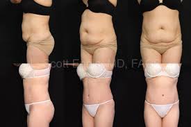 drainless tummy tuck for faster
