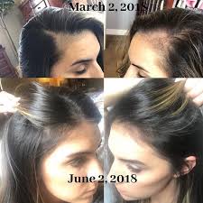 Baby hair loss is perfectly normal, and it often happens within the first six months. Feel Free To Share Candices Testimonial Postpartum Hair Loss Is A Real Yall I Didnt Realize How Much Hair I Lost After Having My Baby But Seeing My 3 Mont