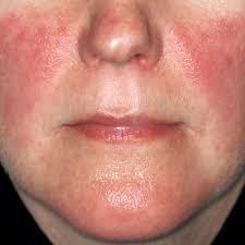 The condition occurs when women with @anon38130 post 9: Skin Lupus Cutaneous Lupus University Of Utah Health