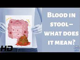blood in stool what does it mean