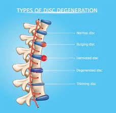 herniated disc what is it and what
