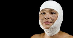 reconstructive surgery for burn victims
