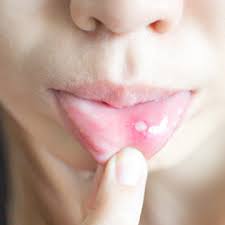 dentist can get rid of your canker sore
