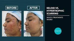 keloid scars meaning treatment and cost