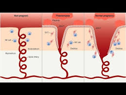 Preeclampsia Pathophysiology Youtube
