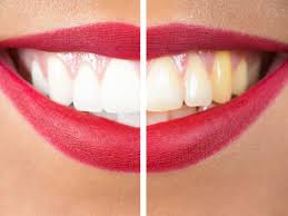 The first two weeks after you've stopped smoking for good are very critical. How To Get Rid Of Yellow Teeth 11 Home Remedies