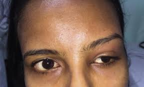 acute lacrimal gland swelling with
