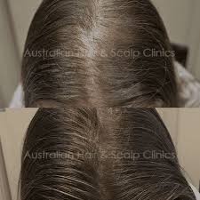 australian hair and scalp clinic