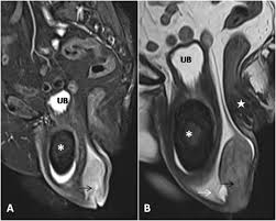 neglected pelvic viscera prolapse