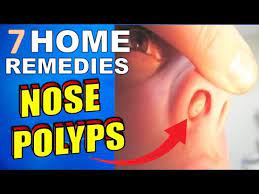 home remes for nasal polyps