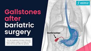 gallstones after weight loss surgery