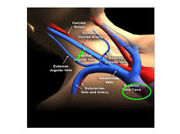 | when the arteries become stiff, it is not possible for them to dilate sufficiently to accommodate a greater blood flow when it's needed. Jugular Venous Pressure And Waveforms Dr Bijilesh Jugular