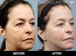 If we will come across more of the affordable rates then we will also let you know. Toronto Facelift Rhytidectomy Toronto Plastic Surgeons